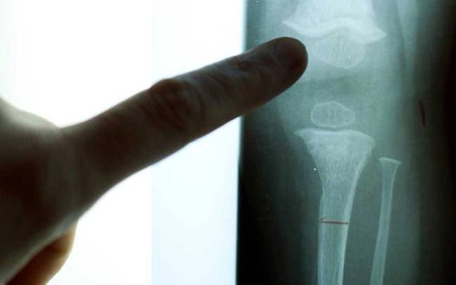 World Osteoporosis Day: Not just women, but men can also be affected with osteoporosis