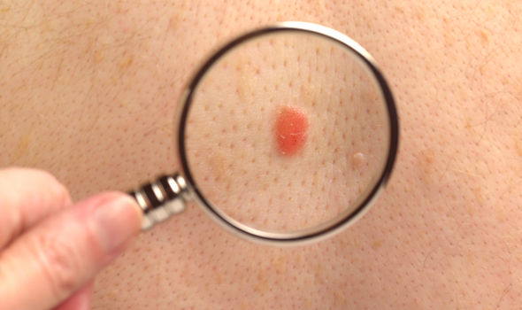 vitamintherapymaypreventdeadlyskincancer:study