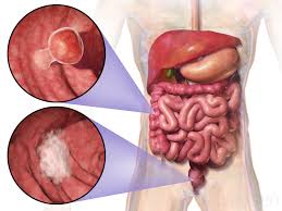 colorectal-cancer-enters-indias-top-five-cancers-in-globocan-2024