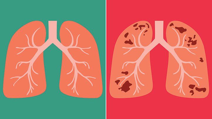 tuberculosis:deadlyinfectiousbutcurabledisease