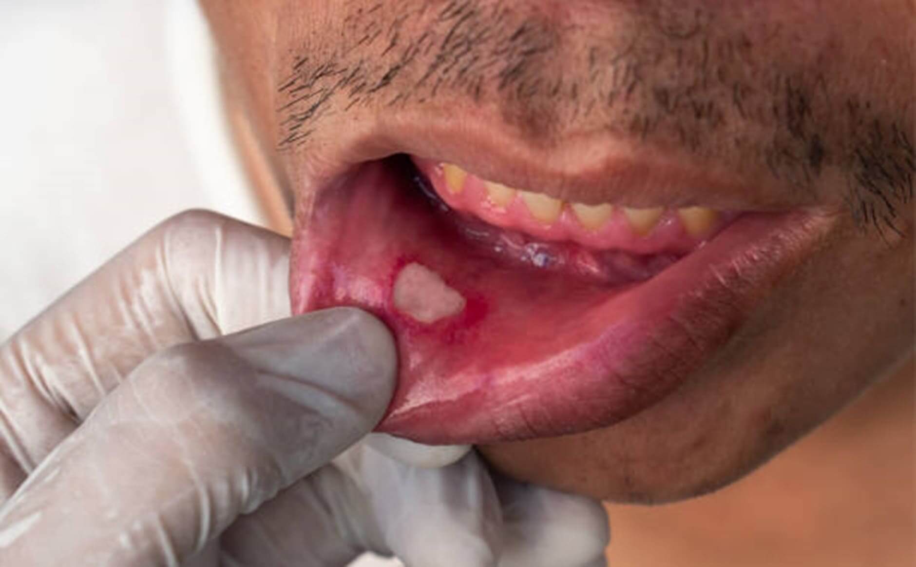 recurringmouthulcerscanbeawarningsignforunderlyinghealthissues
