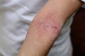 studyrevealsnewantibodytreatmentforflesheatingfungusinfection