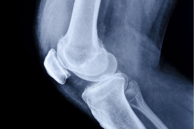 3dprintingcouldhelpfixdamagedcartilage
