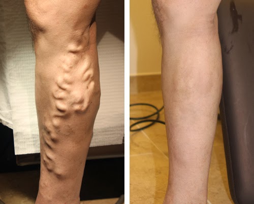 howtogetridofvaricoseveins