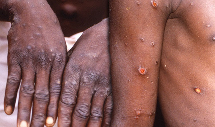 Monkeypox: US reports first case, 14 confirmed in Europe.