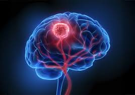 new-cancer-drug-shows-promise-made-brain-tumour-almost-disappear-in-5-days