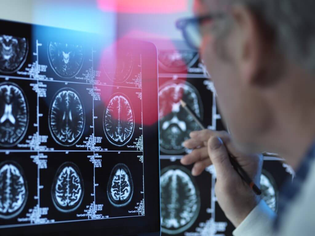 vascularchangesinbrainlinkedtoalzheimersdisease:research