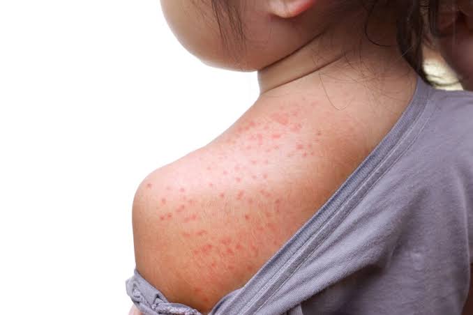 India sees sharp rise in measles cases as public outbreak data stays scarce
