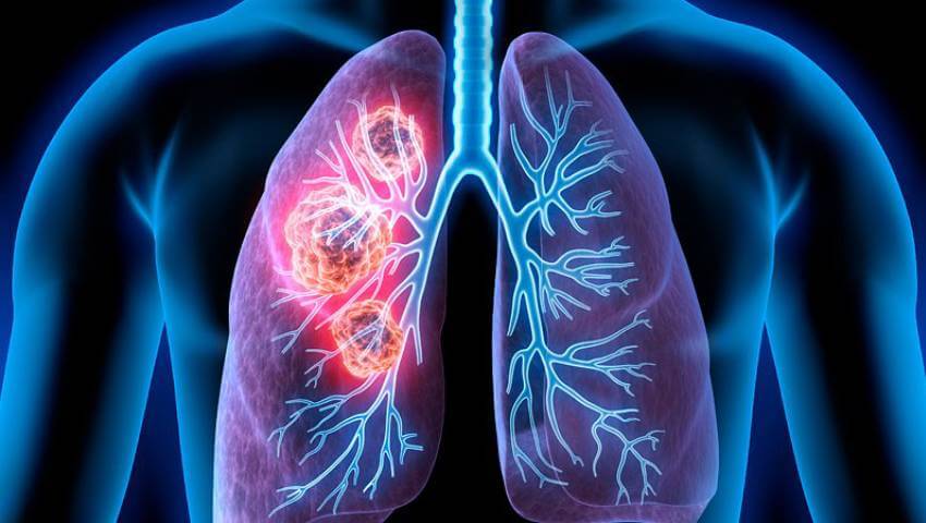 herearesomesignsoflungcanceryoucanspotonyourhandsfeet