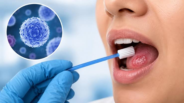 New painless brush test can detect oral cancer in one hour