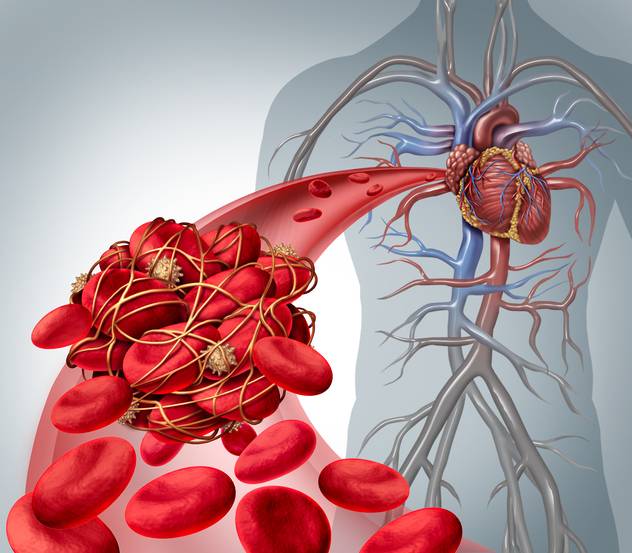 newtoolcandetectsmallstrokecausingclots