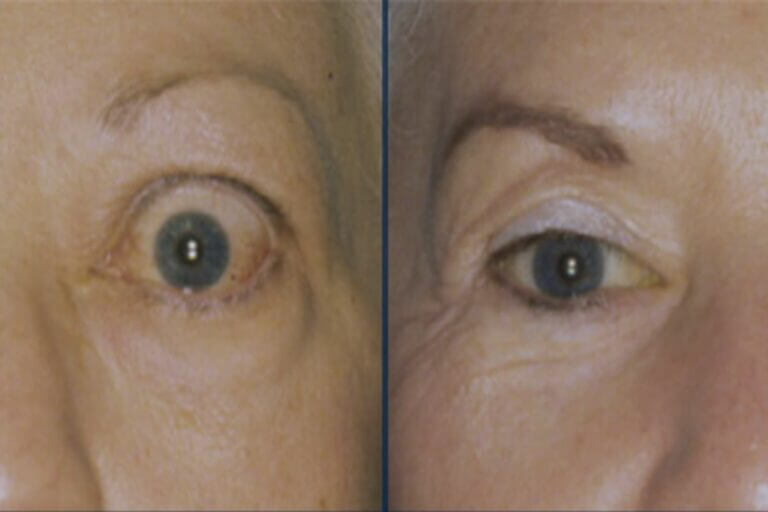 Know the signs, symptoms and treatment options of Thyroid eye disease