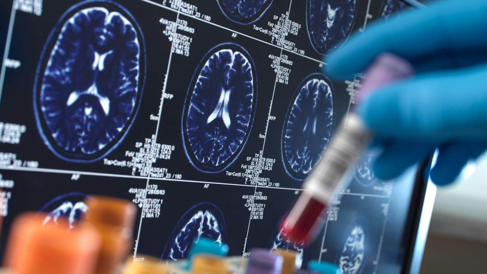 indiagetsfirstalzheimersdrugamidgrowingdiseaseburden