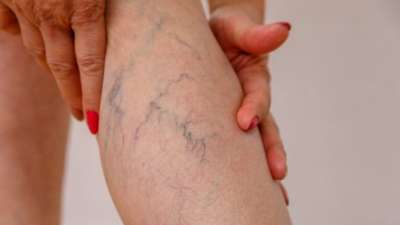 knowthecausessymptomsandtreatmentforvaricoseveins