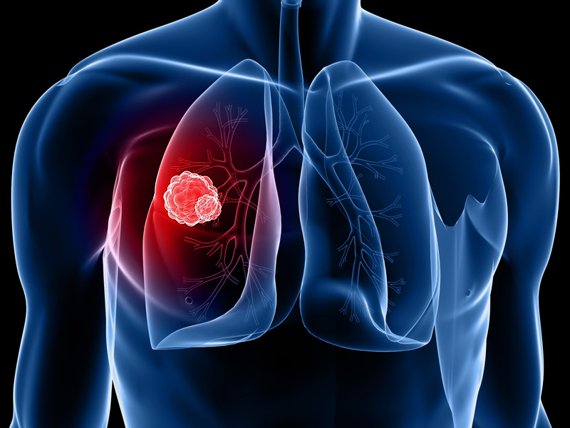 newproteinlinkedtocausinglungcanceridentified:study