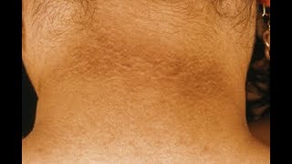 darkneckandskinwartscanbethereasonforprediabetesfulldetails