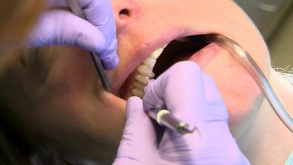 Study reveals how oral infections can trigger risk of stroke
