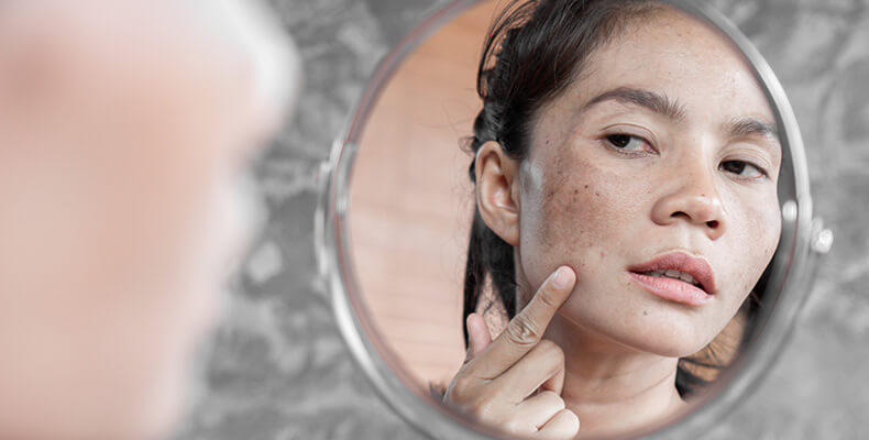 pigmentation(melasma)duringpregnancycheckherethetipstoavoid