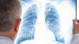 hereare6earlysignsoflungcancerthatcanhelpindiagnosis