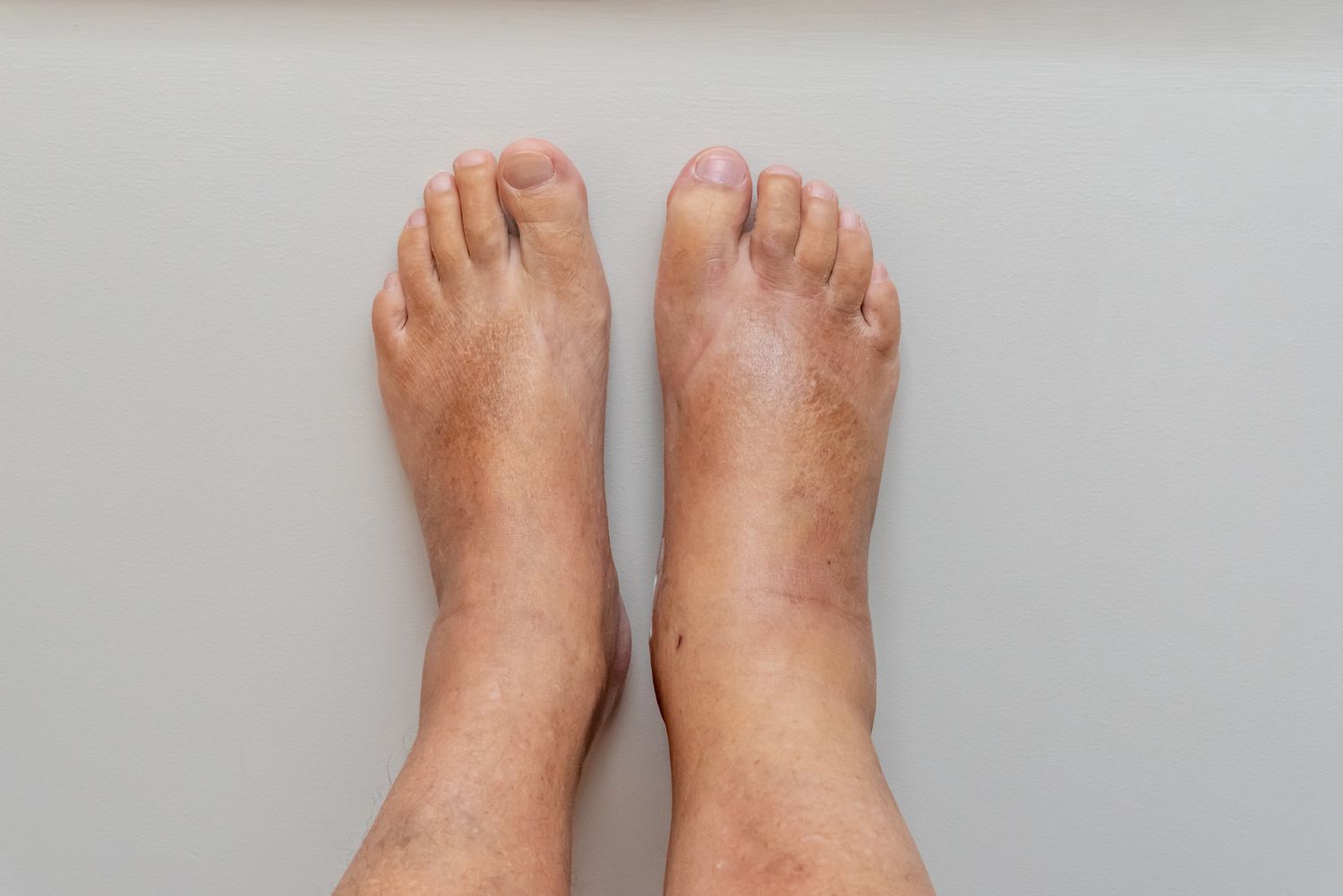Swelling in feet could be signs of kidney trouble