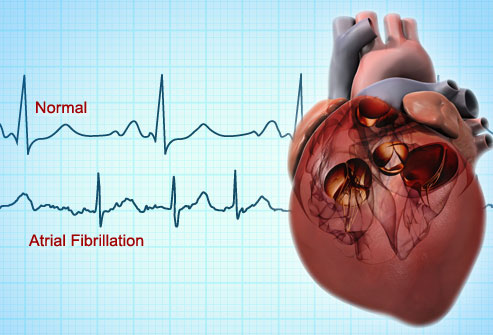 top3afibtreatmentssolutionsmore