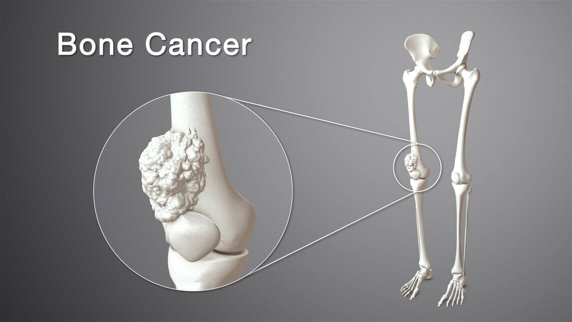 knowthesymptomsandcausesofbonesarcoma