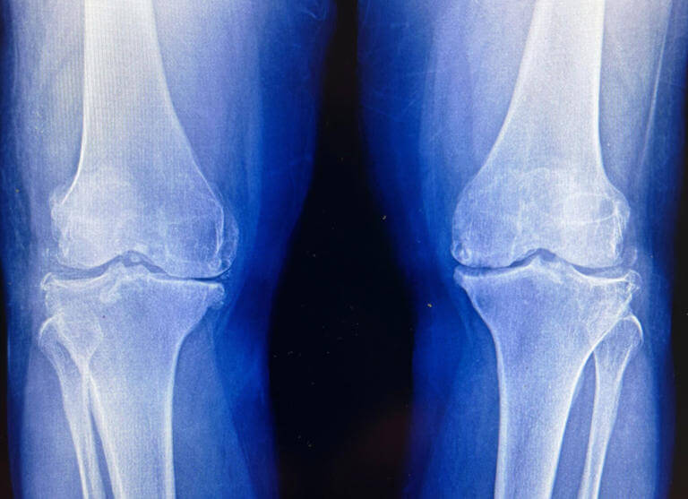 Scientists develop drug that may regrow knee cartilage and stop arthritis