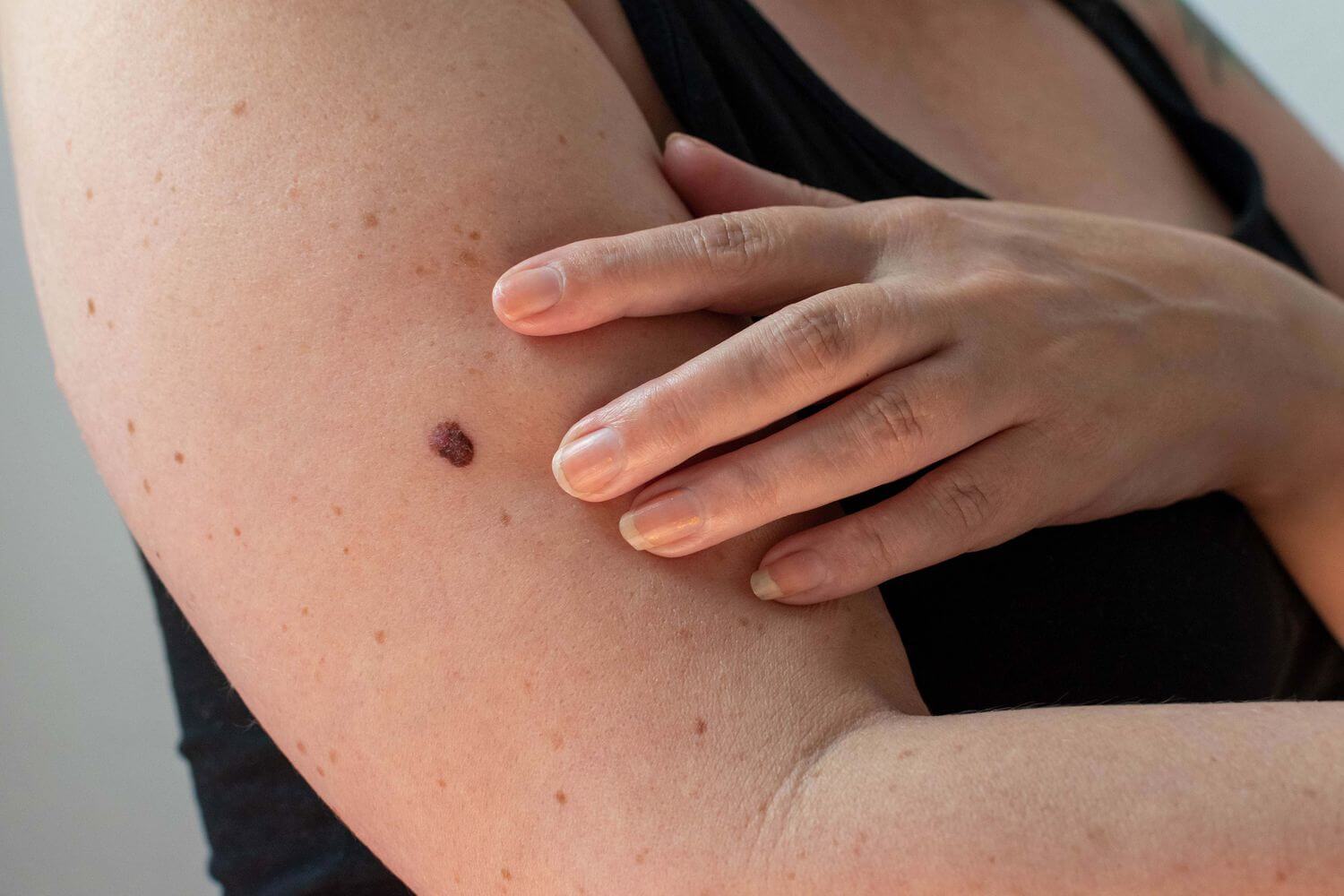 doctorssaysnewgrowthsizeandcolourofmolesmaybeskincancer