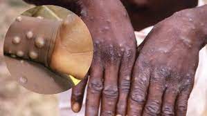 Fifth case of monkeypox reported from Kerala