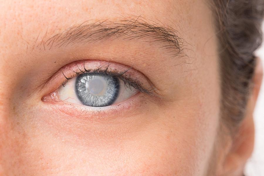 Early warning signs of glaucoma young adults often ignore
