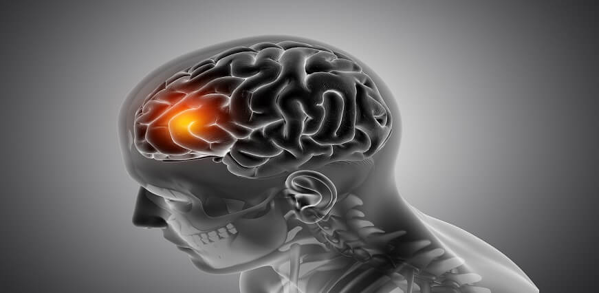 Here are causes, symptoms, treatment, complications of Brain Hemorrhage