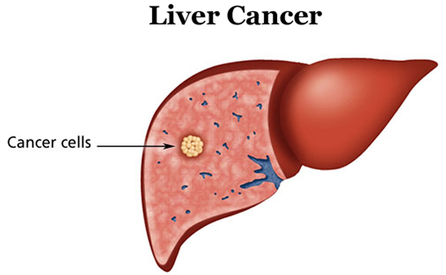 severefattyliverdiseaseboostsriskforlivercancer:study