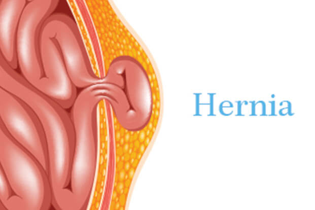 knowtypescausestreatmentofhernia