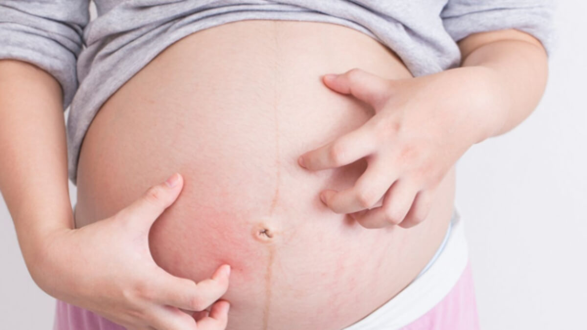5mostcommonskinconcernsfacedduringpregnancy