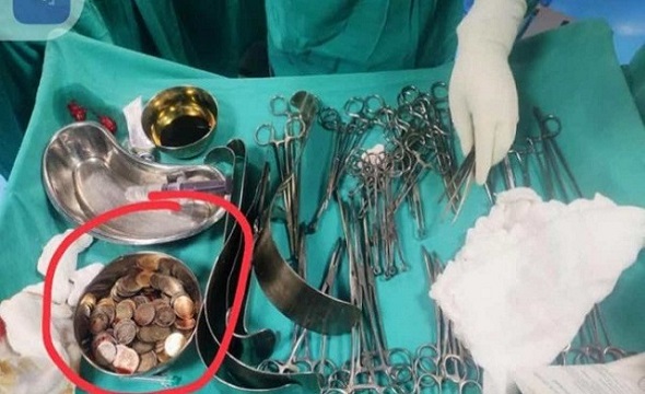 Doctors remove 187 coins from 58-year-old man