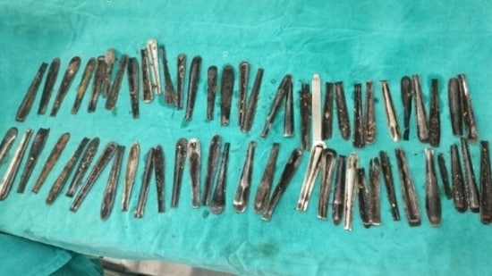 63 spoons found in Uttar Pradesh man’s stomach