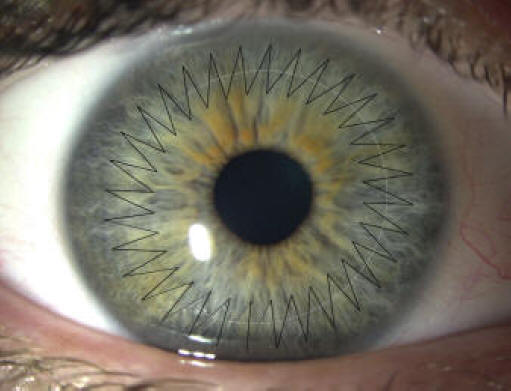 eyehospitalclaimsrecordincornealtransplants