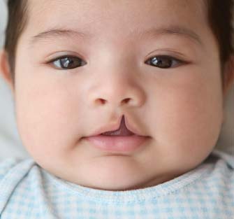 bstctoprovidefreetreatmentforcleftlippalate