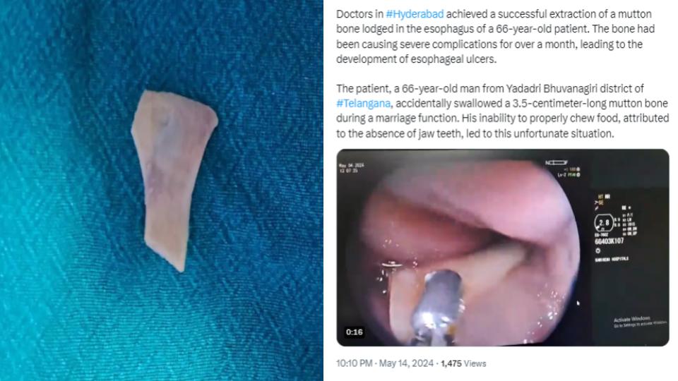 videoofhyderabadhospitalremovesmuttonbonestuckinesophagusofelderlyman