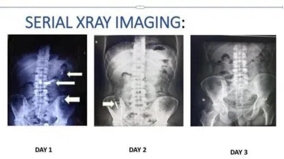 Gandhi Hospital Doctors successfully removes blade swallowed by a man