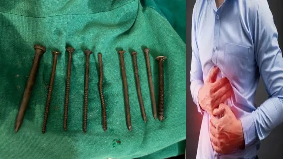 doctorsremove9ironnailsfromcherlapallyremandprisoner’sstomach