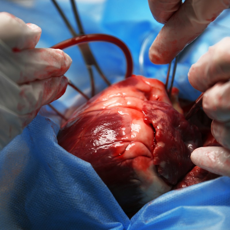 hitechheartpumpdeviceimplantedbyapolloheartsurgeonsfor70yearold