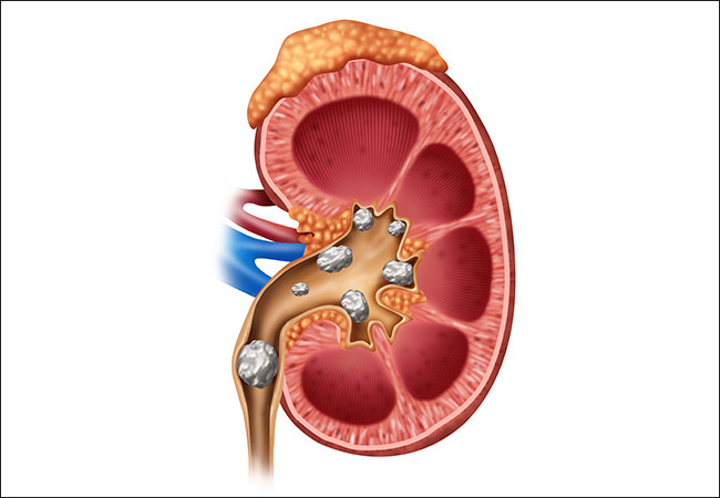 kidneystonesremovedfromworldsyoungestpatientinhyderabad