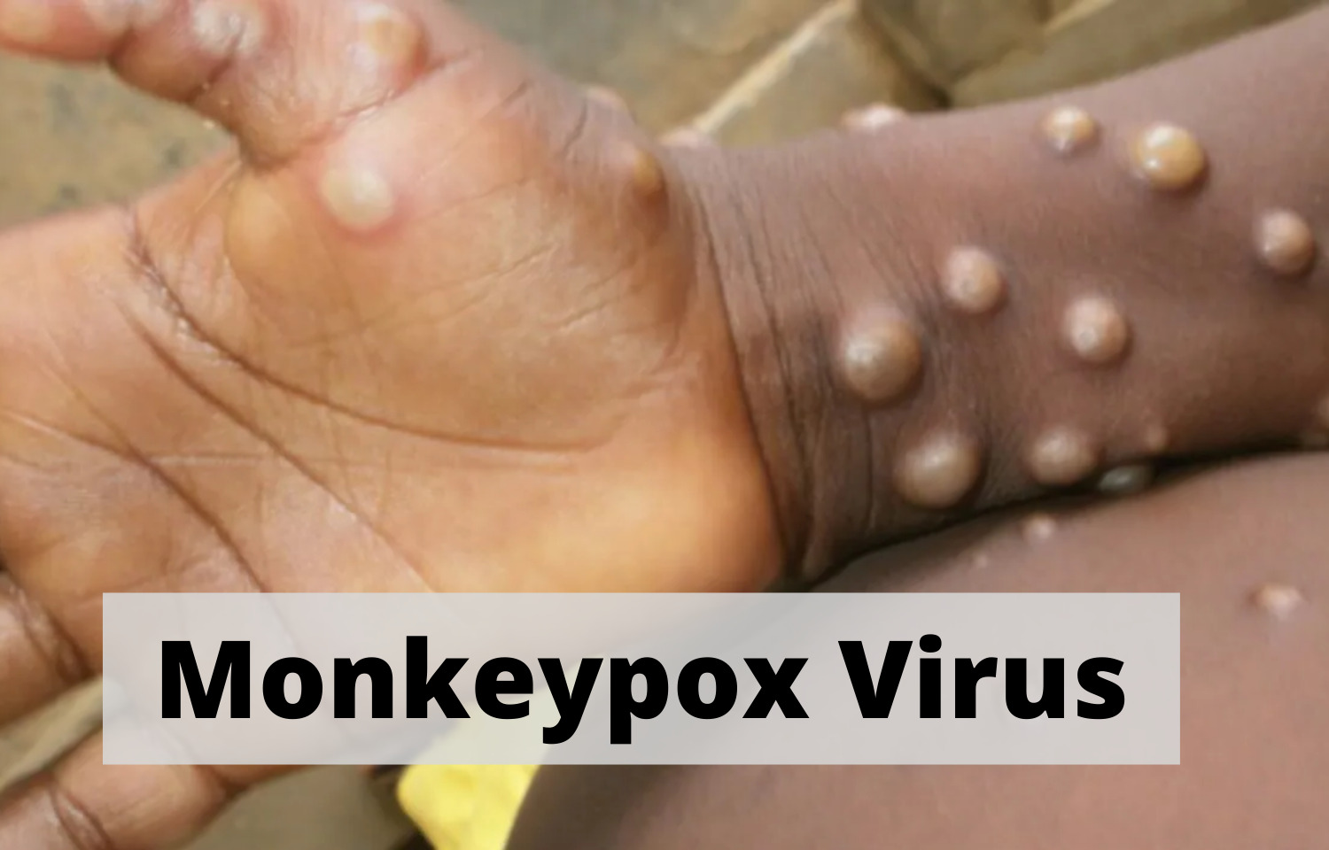 canadaconfirms58casesofmonkeypox