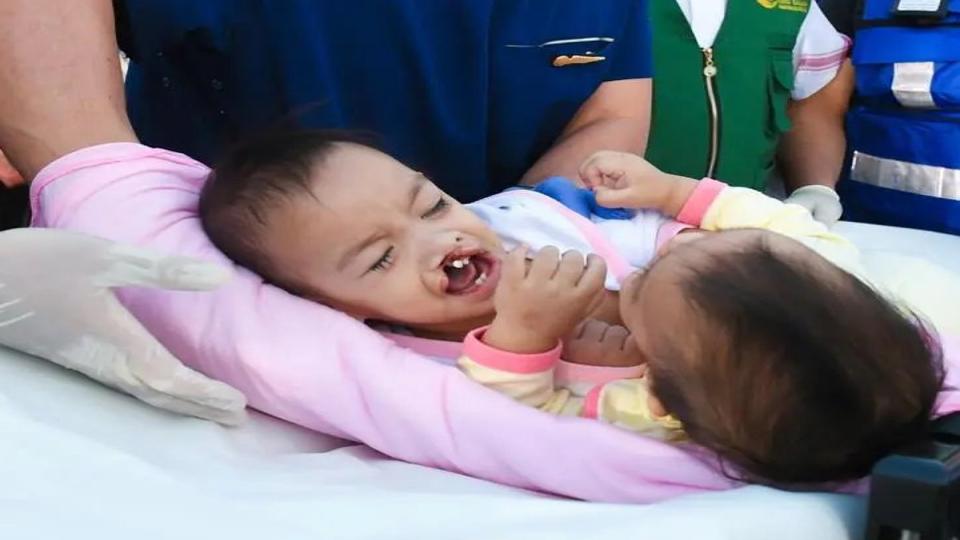 Filipino conjoined twins arrive in Riyadh for surgery