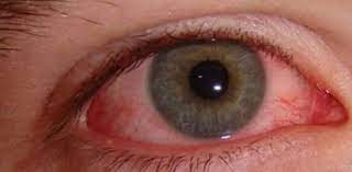 85 new cases of Pink Eye infection reported in Pakistan’s Lahore