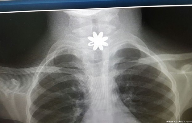 7yearoldgirlwhoswallowedgoldnecklacesaved