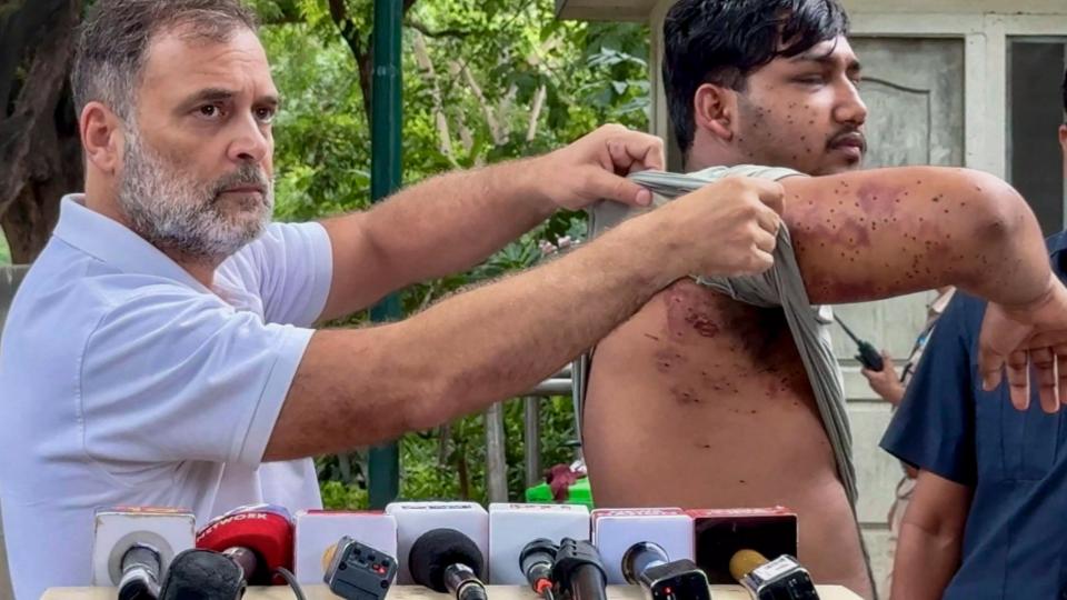 Rahul Shows Pellet Injuries, Demands End to 