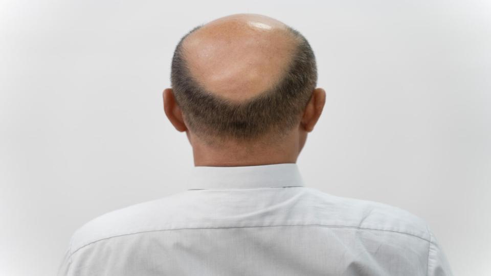baldman’smiraculous‘hairgrowth’formulainmeerutlandshiminjail!