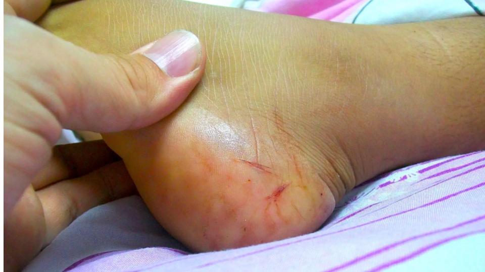 Nurse Bitten By Snake At Health Sub-Centre In Kerala